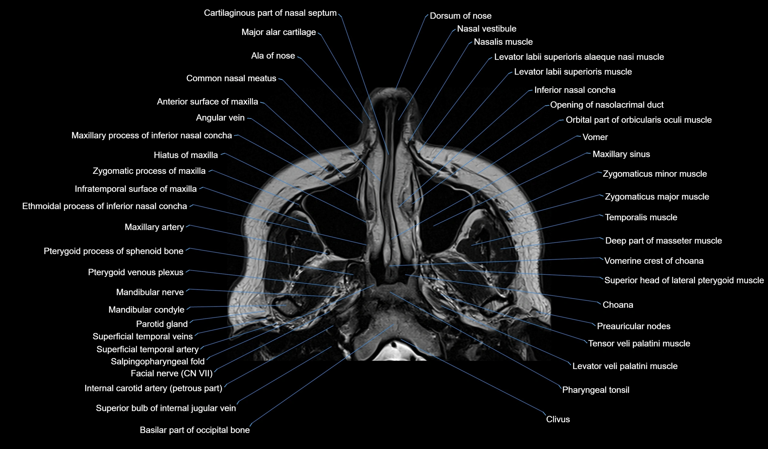 MRI face & paranasal sinuses(PNS) labelled  coronal  cross sectional anatomy 3T radiology  image-img-00001-00010.webp
